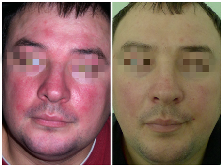 MIRVASO – NAUJAS ŽINGSNIS ROŽINĖS (ROSACEA) GYDYME